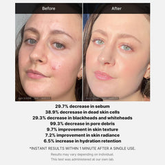 Medicube Red Acne AHA BHA Succinic Acid Skin Peel Serum - 40g